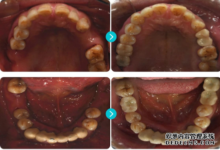 雙側后牙頜牙列缺