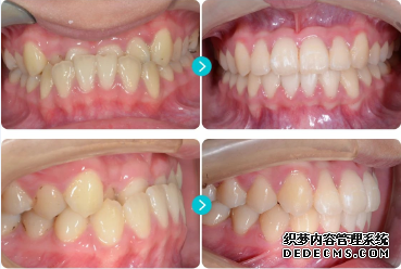 00牙列擁擠 牙齒排列不齊